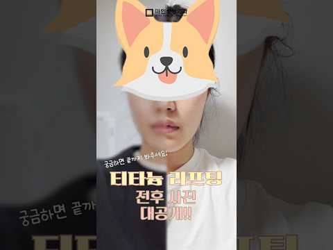 티타늄리프팅, 탄력 있고 슬림한 V라인으로 변신! 💖 #티타늄리프팅 #리프팅레이저 #마인피부과