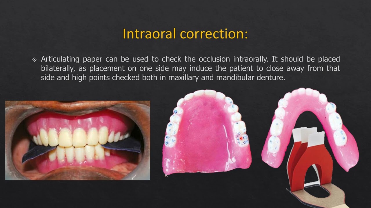 THE INITIAL DENTURE PLACEMENT, SELECTIVE GRINDING AND POST-DENTURE