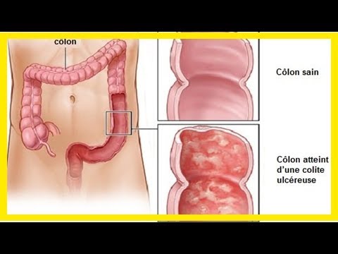 Vidéo: Colite - Traitement De La Colite Intestinale Avec Des Remèdes Populaires, à La Maison