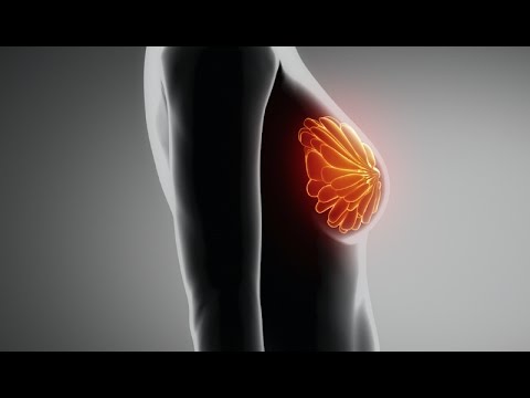 Video: 3D-mammogram: Kostnad, Resultater Og Mer