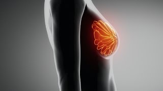 Mammography: 3D Tomosynthesis