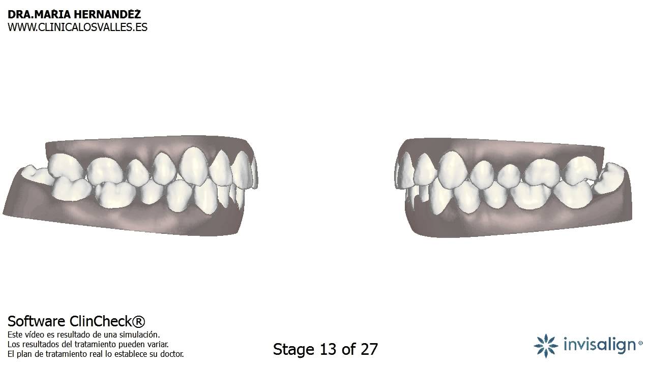 Planificación 3D de Caso Clínico de apiñamiento y mordida cruzada con ortodoncia