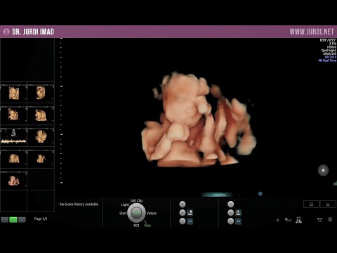 Videó: 22. Terhességi Hét - Magzati Változások, Has, Fájdalmak, Vizsgálatok, Ultrahang