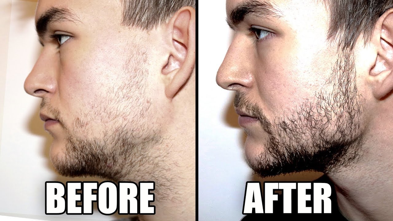 Featured image of post Minoxidil Beard Before And After Reddit Use a soap meant for your face or simply use plain water