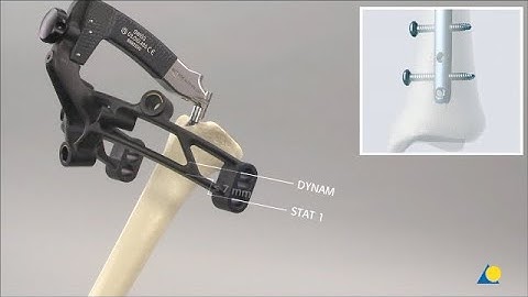 Tibia, Shaft - Fracture - Closed Reduction and Reamed Intramedullary Nailing Using the ETN
