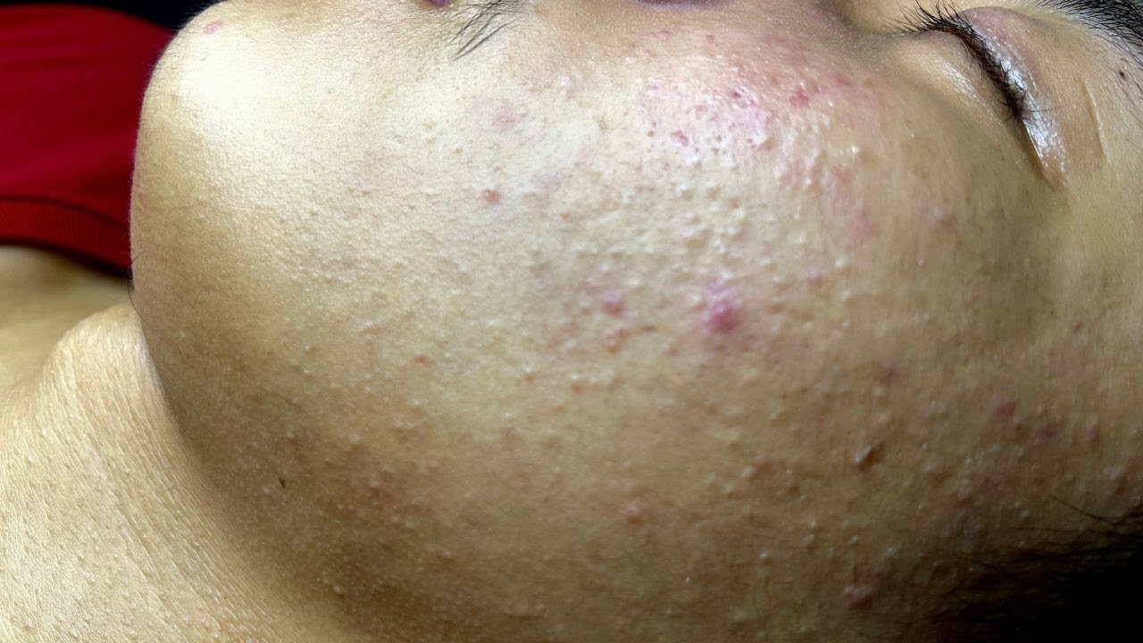 Relaxing Acne Treatment Everyday With Vu Quynh Mi Spa|Blackheads Removal| Cystic Removal 2023 |048