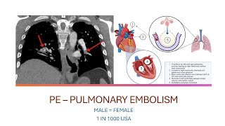 Pulmonary EMBOLISM: The SILENT THREAT Lurking in Your LUNGS!  #Embolism #PE #LungHealth #Awareness