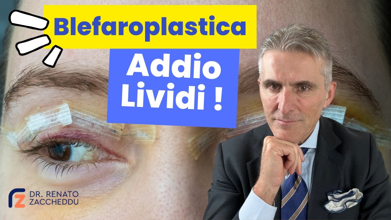 Come Ridurre i Lividi Dopo la Blefaroplastica