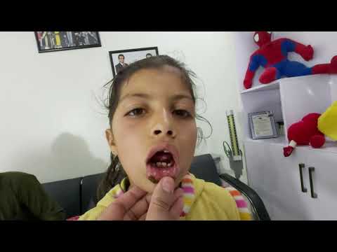 Video: Stomatitt Hos Barn: årsaker, Symptomer, Behandling