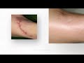 Scar Treatments at Beautiful You By Christine