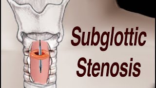 Adult Subglottic Stenosis Treatment