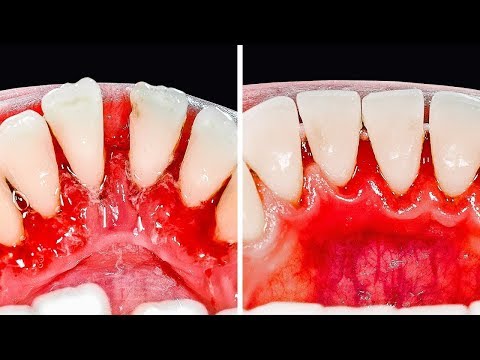Video: Cum Să Vă îngrijiți Dinții în 30 De Ani