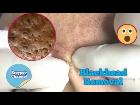 Blackhead removal | cystic acne   Ep 
