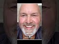 Confidence Without Crowns or Implants