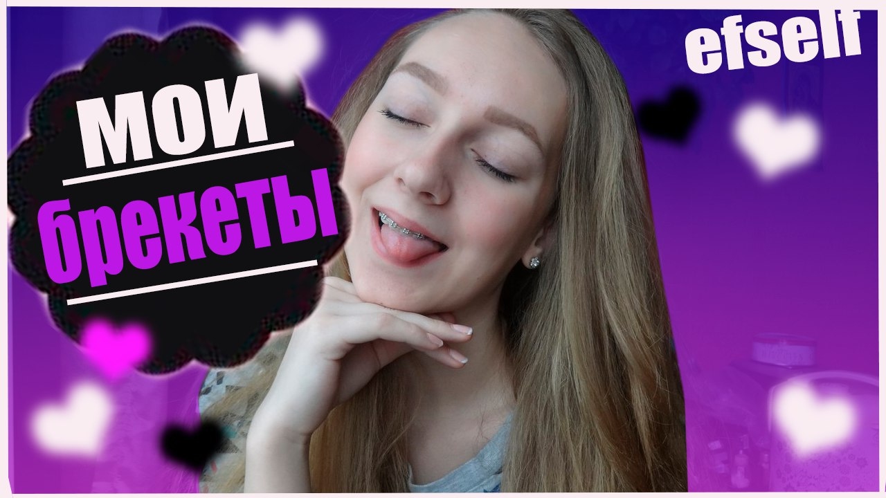 Вся правда о брекетах. Моя история. Больно ли ставить брекеты? - YouTube