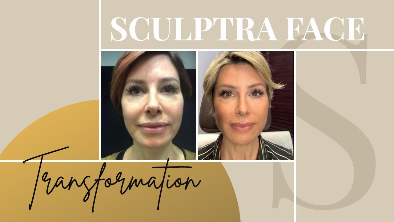 Sculptra Before & After | My Review on the Non-Surgical Facelift | Dominique Sachse
