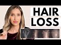 Hair Loss: Dermatologist Shares What Causes it & the Best Treatments (Minoxidil & More!)