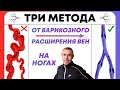 Варикозные узлы на  ногах. Сосудистые Звёздочки - Три Хороших Метода Профилактики Варикоза!