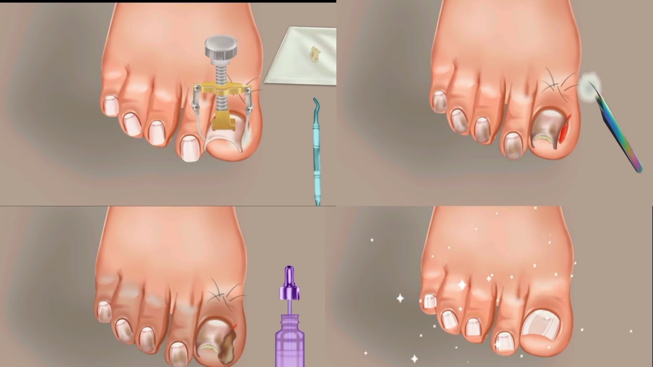 Nail Clean Video | ASMR Hospital Doctor Games | 