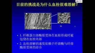 SCAI Joint Session EKOS Thrombolysis for Pulmonary Embolism Thach Nguyen