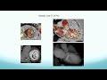 Procedural Planning for TMVR With CT - John Lesser, MD