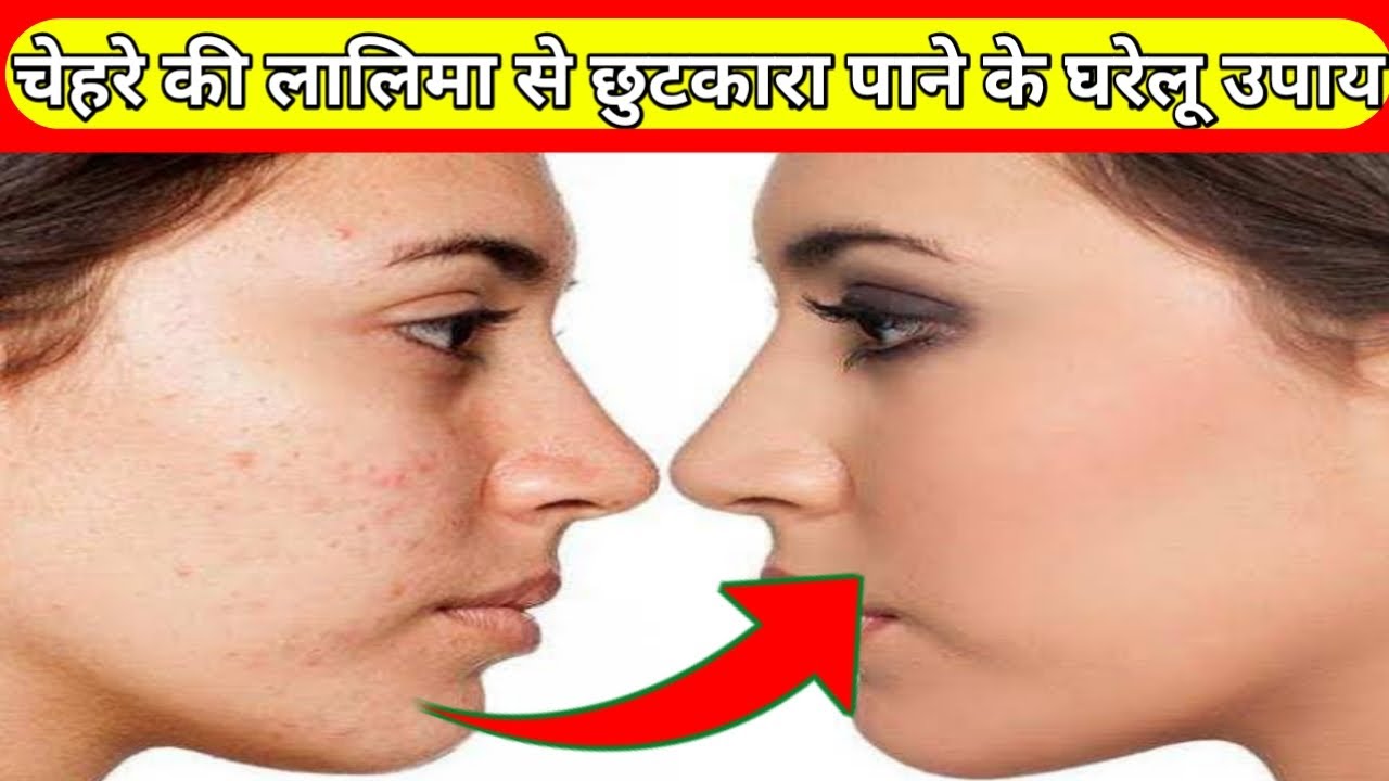 chehre ki redness hatane ke upay face ki redness ka ilaj face ki