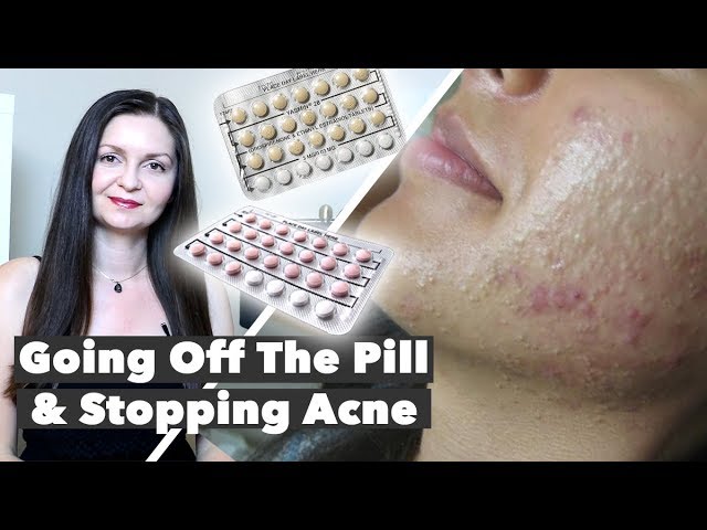 Coming Off Birth Control Acne - Hormonal Acne Treatment - Post Pill