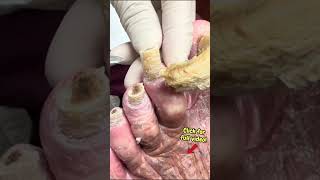 Part 6: Insane Thick Nail Cutting ASMR 😳 #satisfyingshorts #shorts #nailcutting #asmrsound