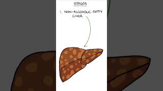 Stages of Non-Alcoholic Fatty Liver Disease #medicine #gastroenterology
