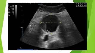 Anévrisme de l'aorte en échographie: forme sacciforme mycotique