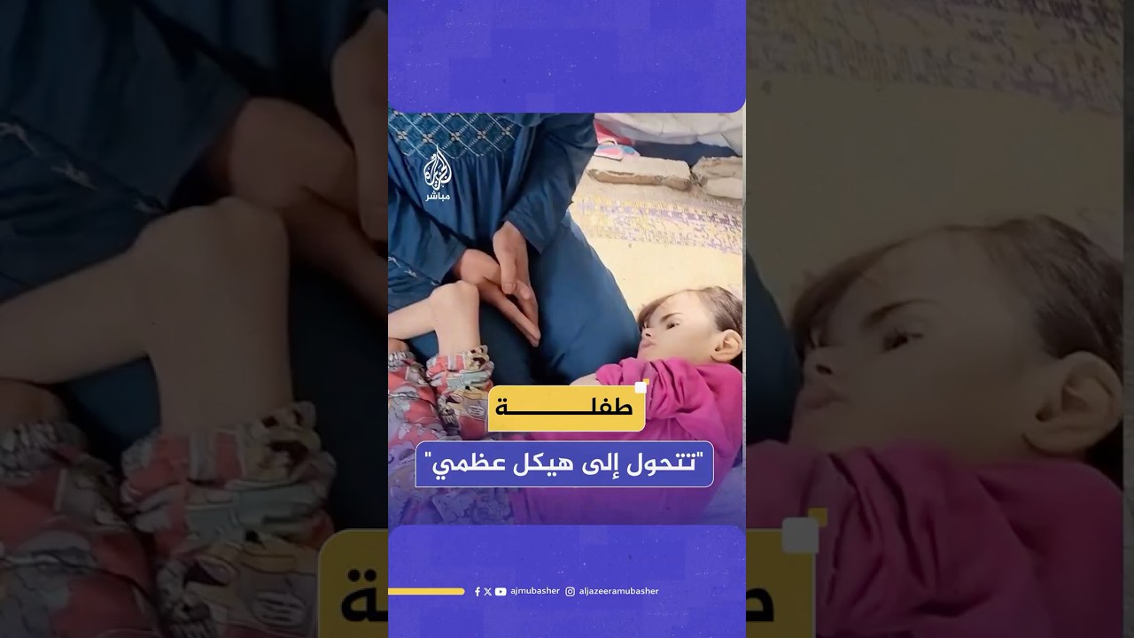 مأساة طفلة فلسطينية تتحول إلى هيكل عظمي جراء الحصار وسياسة التجويع التي يفرضها الاحتلال على قطاع غزة