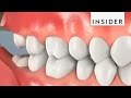 Why Do We Remove Wisdom Teeth?