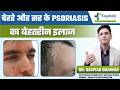 Scalp Psoriasis से Face पर लाल पैच क्यों आते हैं? | face and scalp Psoriasis | Psoriasis treatment
