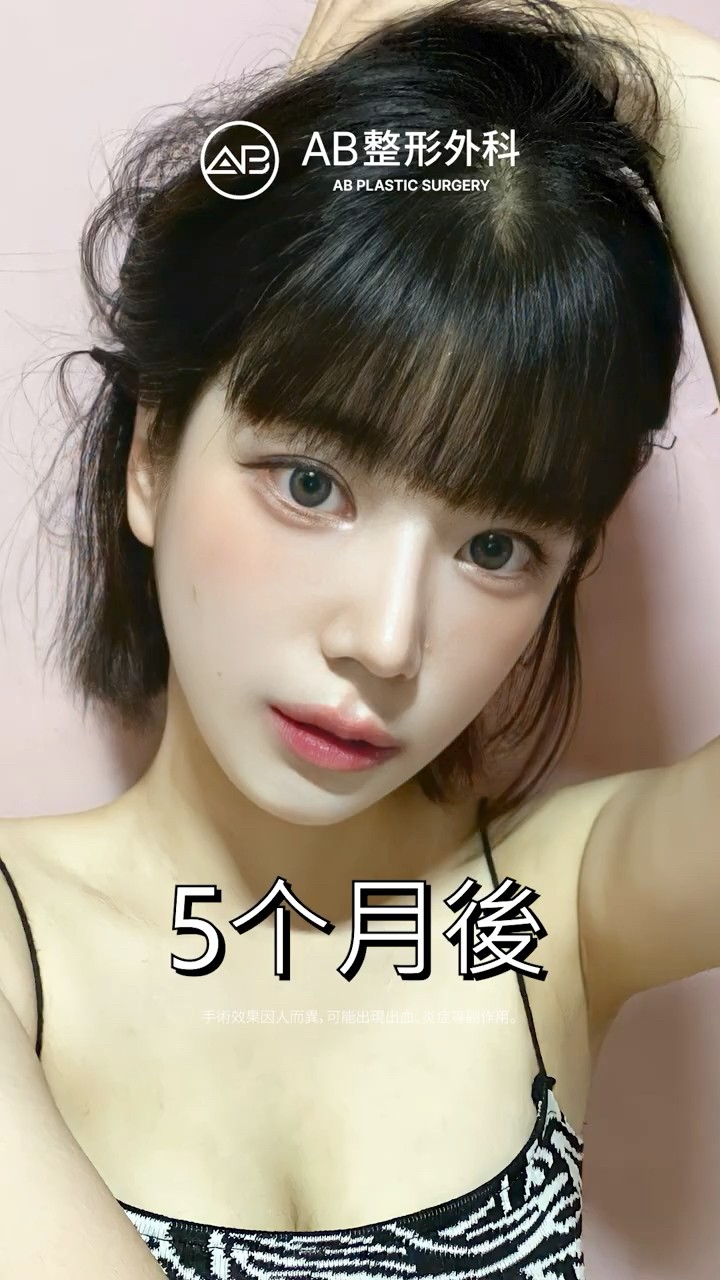 鼻整形後，更喜歡現在的自己了💕 #Shorts