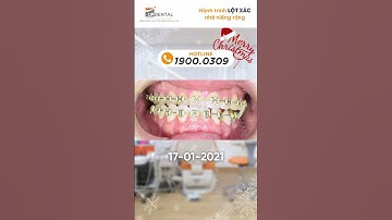 Hành trình LỘT XÁC nhờ niềng răng của Thanh Xuân