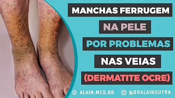 O que pode ser veias escuras?