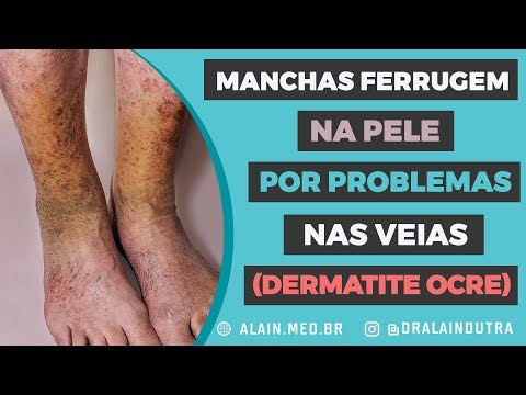 Vídeo: O Ar Poluído Está Associado à Formação De Manchas Escuras Na Pele - Visão Alternativa