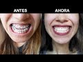 Antes y después, cirugía ortognatica/maxilofacial