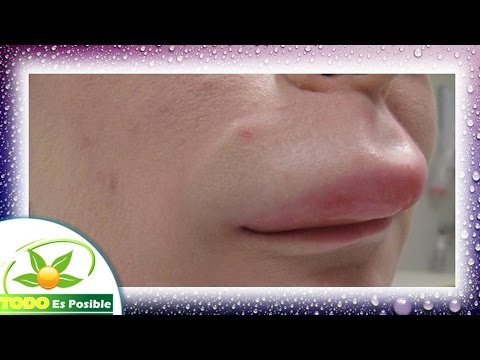 remedios+caseros+para+desinflamar+la+picadura+de+avispa
