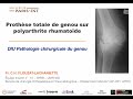 12  ptg sur polyarthrite rhumatode