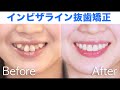 インビザライン抜歯矯正【八重歯,前歯ガタガタ,過蓋咬合】マウスピース矯正の後に上顎前歯の補綴治療