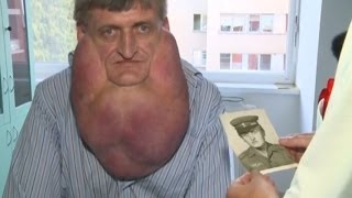 Massive Tumor Removed from Man's Face