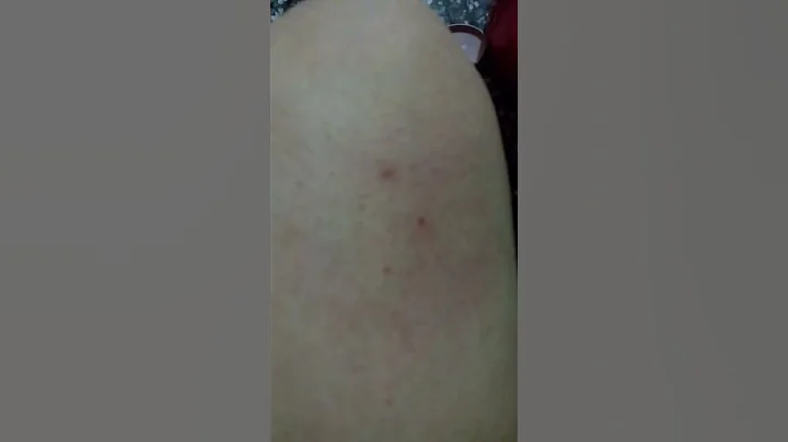 R220666029 摸起來像雞皮疙瘩 粗粗的 我是他ㄚ 從小給我那麼胖 - 天天要聞