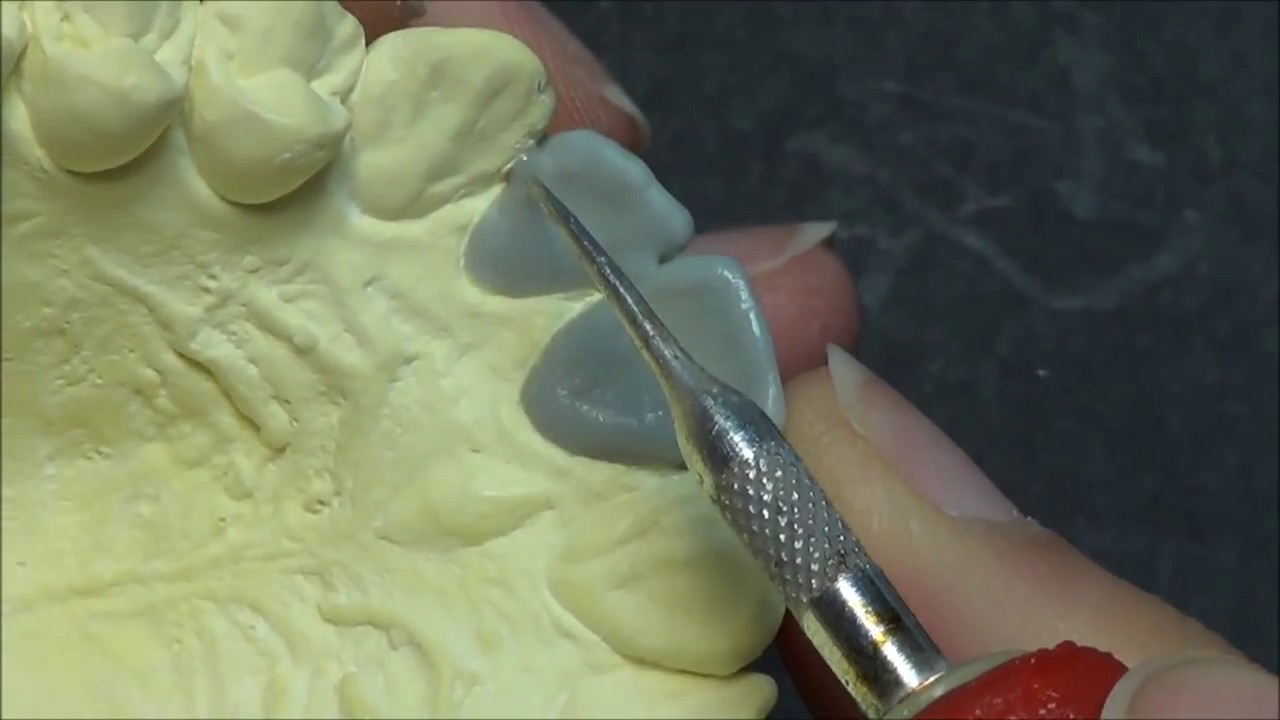 Live wax up - Upper Lateral incisor