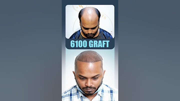 6100 Grafts Hair Transplant in Kolkata #hairtransplant #kolkata #shorts #ytshorts