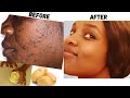 Remove Dark Spots In 10 Days with Potato Cream  | How To Get Rid Of Pimples and Acne