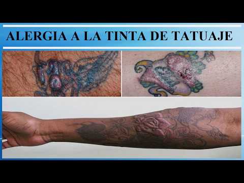 ALERGIA A LA TINTA DE TATUAJE