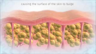 Shockwave Therapy - Cellulite Treatment