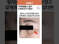 쥬베룩볼륨vs필러, 눈밑꺼짐에 뭐가 답이냐고?