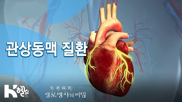 [생로병사의 비밀] 714회 핫클립? - 관상동맥 질환 치료법?